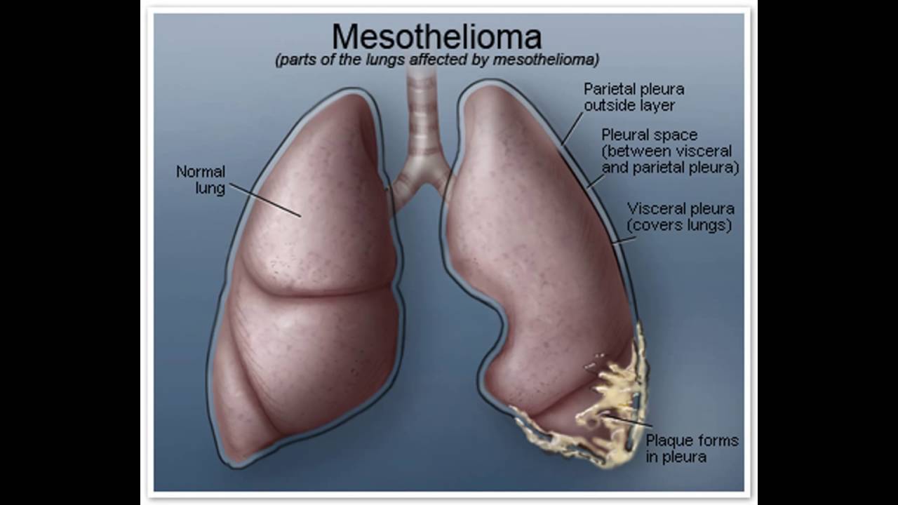 mesothelioma stratified therapy